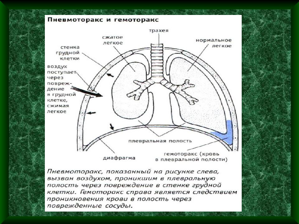 Грудная стенка. Пневмоторакс и гемоторакс. Грудная полость границы и стенки. Гемоторакс грудной клетки. Пневмоторакс гидроторакс гемоторакс.