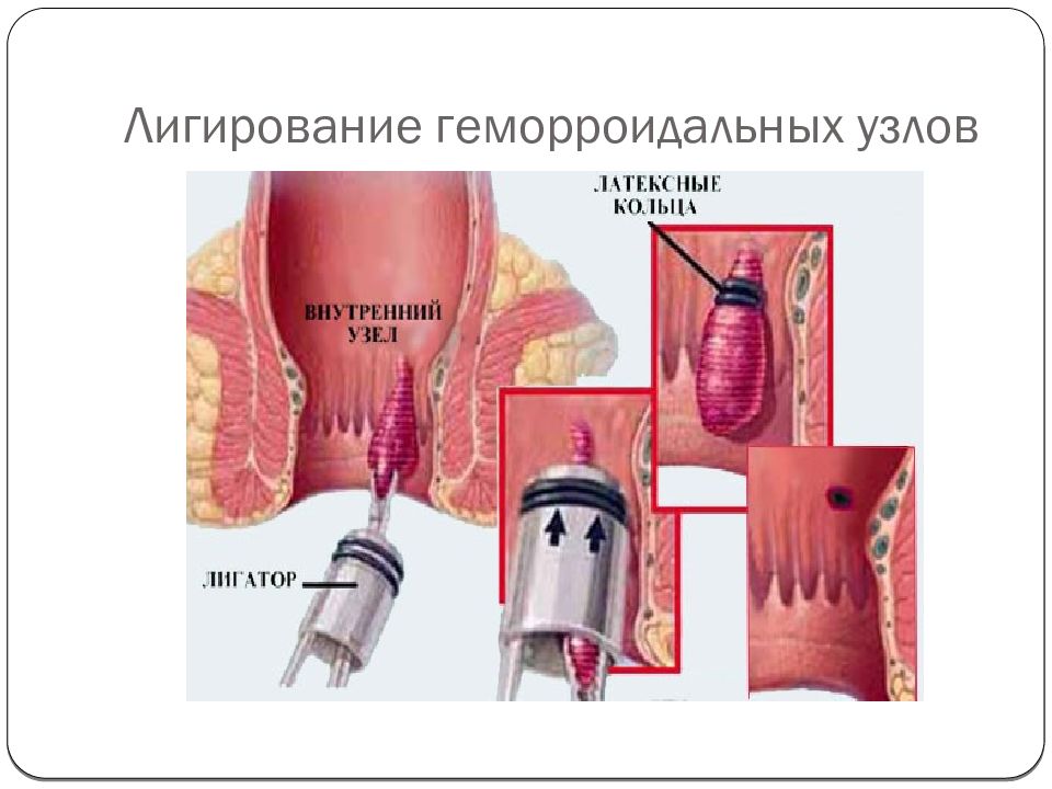 Как убирают геморроидальные узлы операция