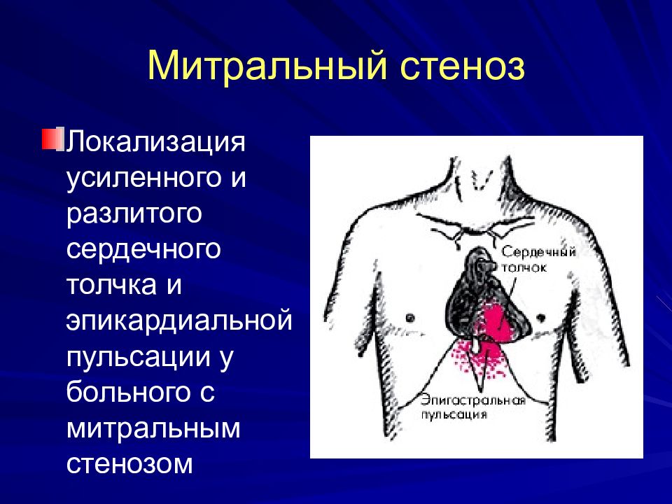 Область сердца. Сердечный толчок локализация. Митральный стеноз верхушечный толчок. Митральный стеноз пальпация перкуссия аускультация. Верхушечный толчок при митральном стенозе.