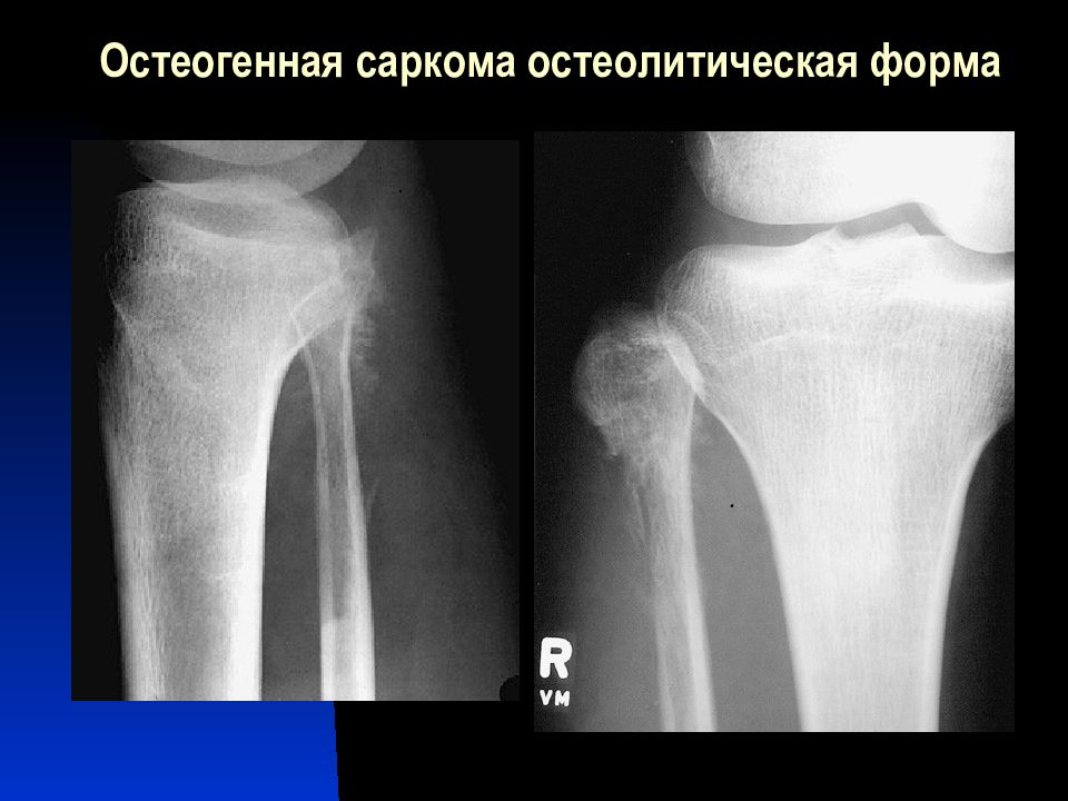 Саркомы костей нмо. Саркома коленного сустава рентген. Остеогенная саркома большеберцовой кости. Остеогенная саркома бедренной кости рентген. Саркома Юинга плечевой кости рентген.