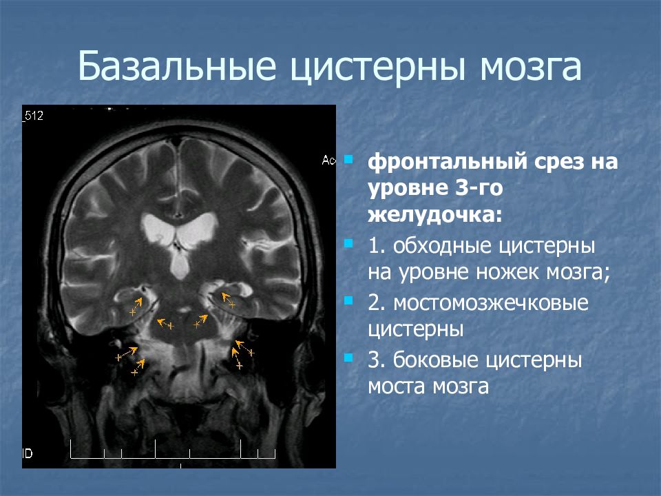 Базальные цистерны головного