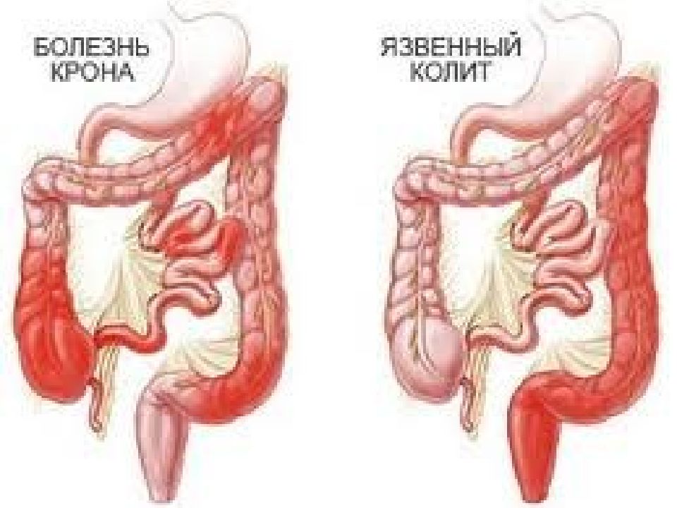 Колика при колите