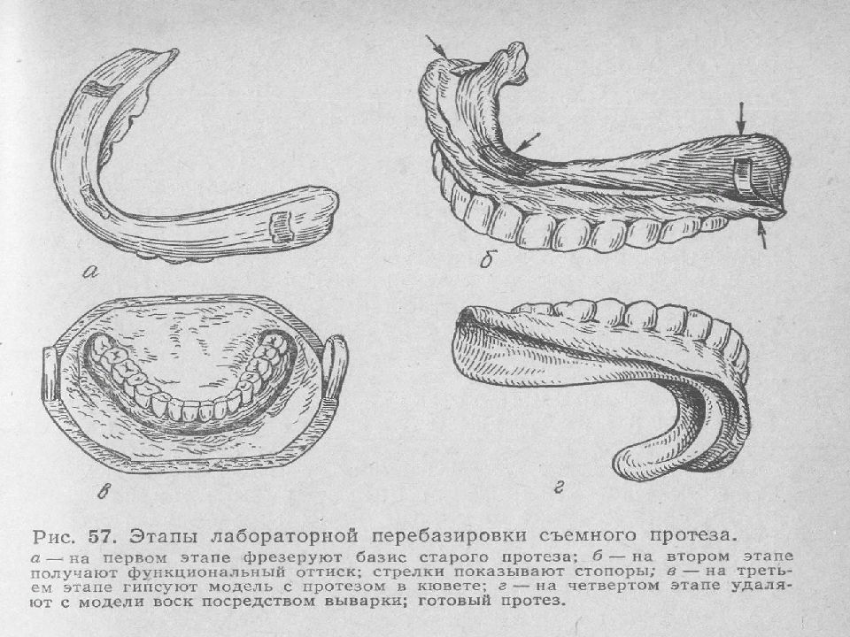 Протезное ложе. Классификация съемных пластиночных протезов. Съемный пластиночный протез рисунок. Пластиночный протез схема. Нарисовать на модели пластиночный протез.