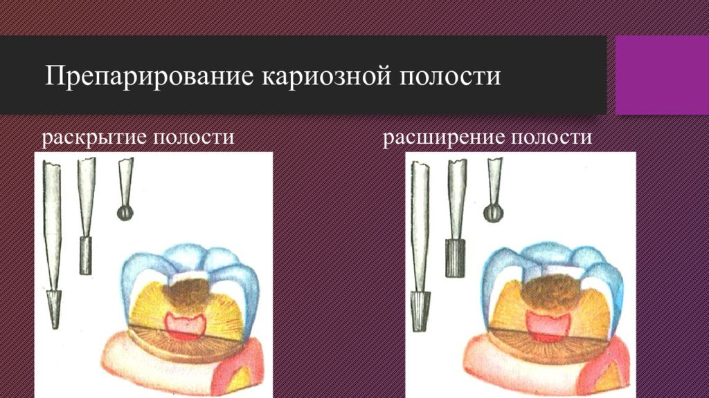 3 класс кариозной полости