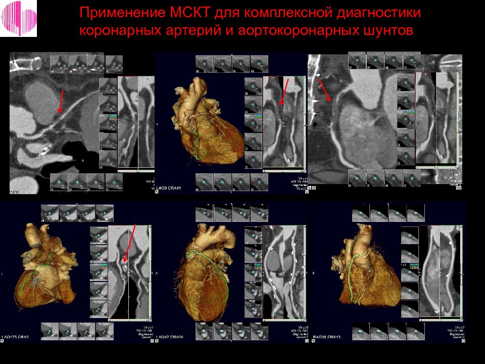 Мскт коронарных артерий с контрастированием. Мультиспиральная томография сердца и коронарных сосудов это?. Мультиспиральная компьютерная томография (МСКТ) коронарных артерий. МСКТ сердца и коронарных сосудов с контрастом.