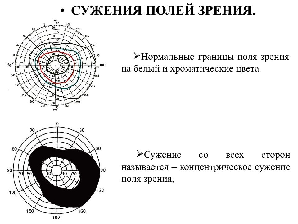 Нормальные границы. Концентрически сужено поле зрения. Сужение периферического поля зрения. Нормальные границы поля зрения на белый и хроматические цвета. Концентрическое выпадение полей зрения.