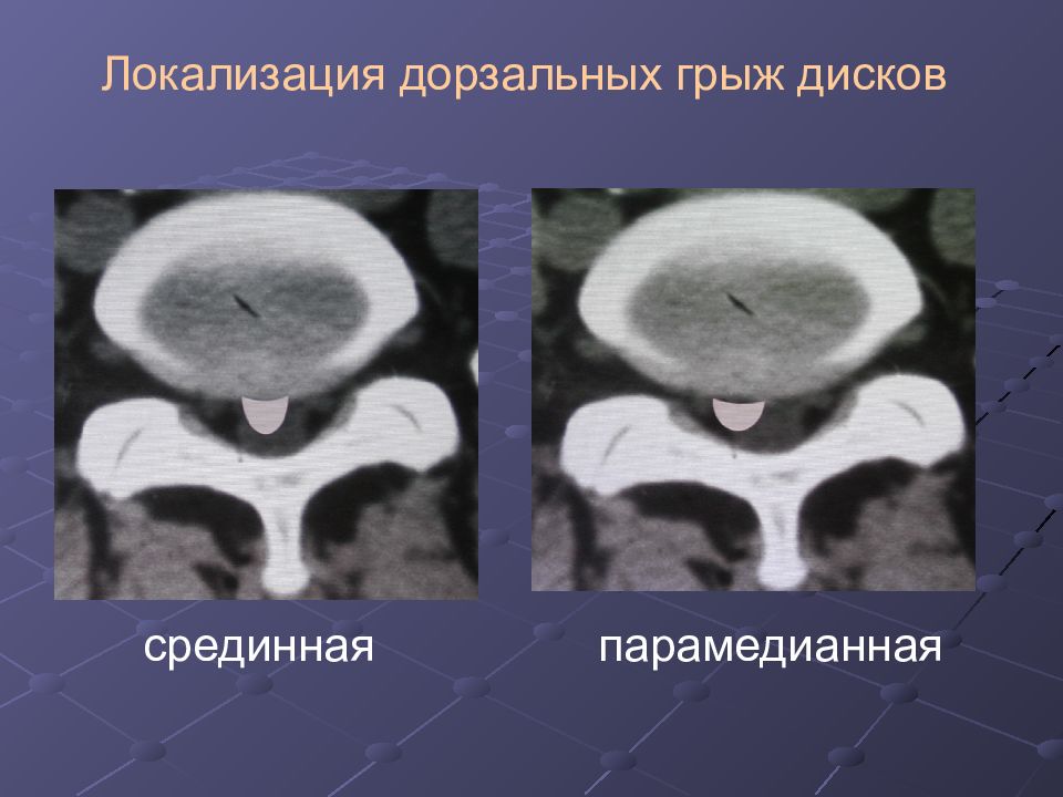 Дорзальная грыжа. Дорзальная билатеральная парамедианная грыжа что это такое. Дорзальная медиальная грыжа. Дорзальная парамедианная грыжа диска. Локализация грыж дисков.