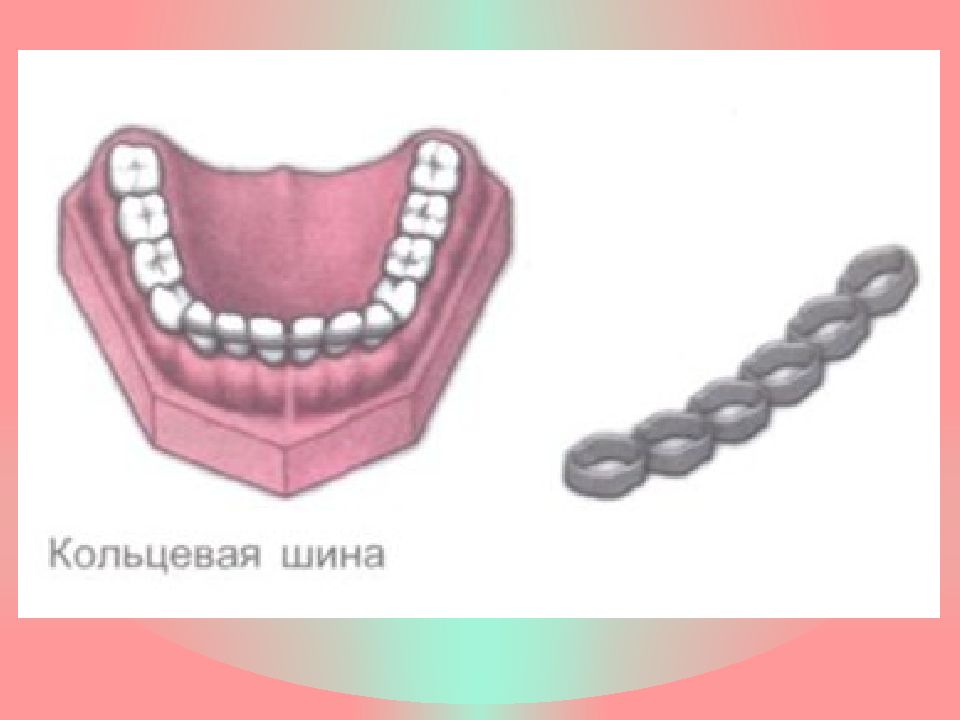 Постоянное шинирование при заболеваниях пародонта презентация