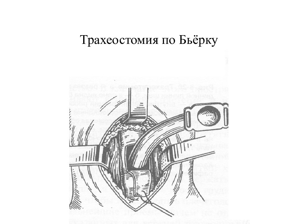 Наложение трахеостомы. Техника операции трахеостомии по Бьёрку. Трахеостомия фенестрация. Продольная трахеостомия. П образная трахеостомия по Бьерку.