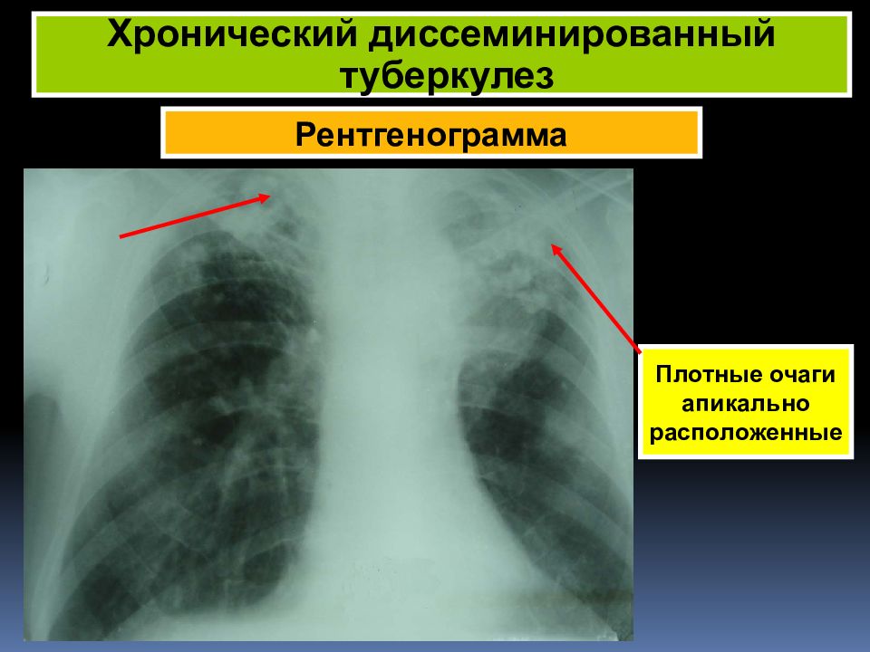 Диссеминированный туберкулез фаза инфильтрации. Острый диссеминированный туберкулез рентген. Хронический диссеминированный туберкулез рентген. Гематогенно диссеминированный туберкулез. Гематогенно диссеминированный туберкулез рентген.