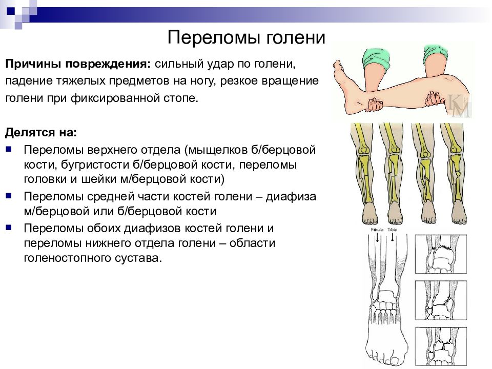 Переломы голени презентация