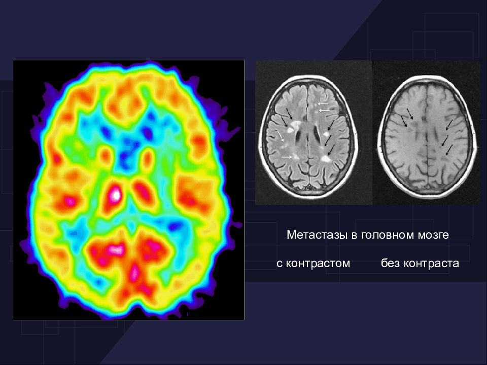 Головной мозг контрастом. Метастазы в головном мозге. Метастазы в головной мозг без контраста. Метастазы в головном мозге презентация. Метастазы в головной мозг на мрт без контраста.