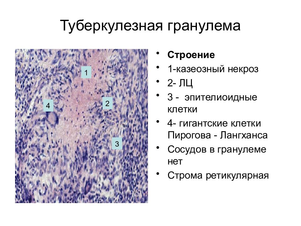 Туберкулезная гранулема рисунок