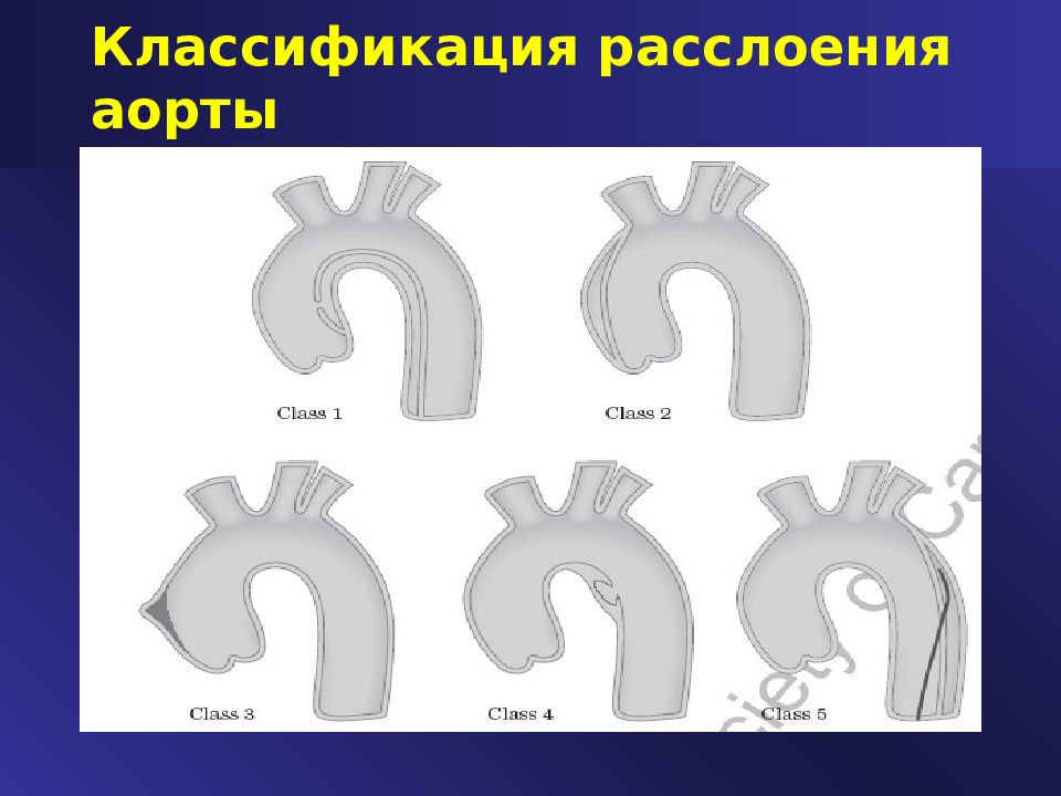 Расслоение аорты презентация