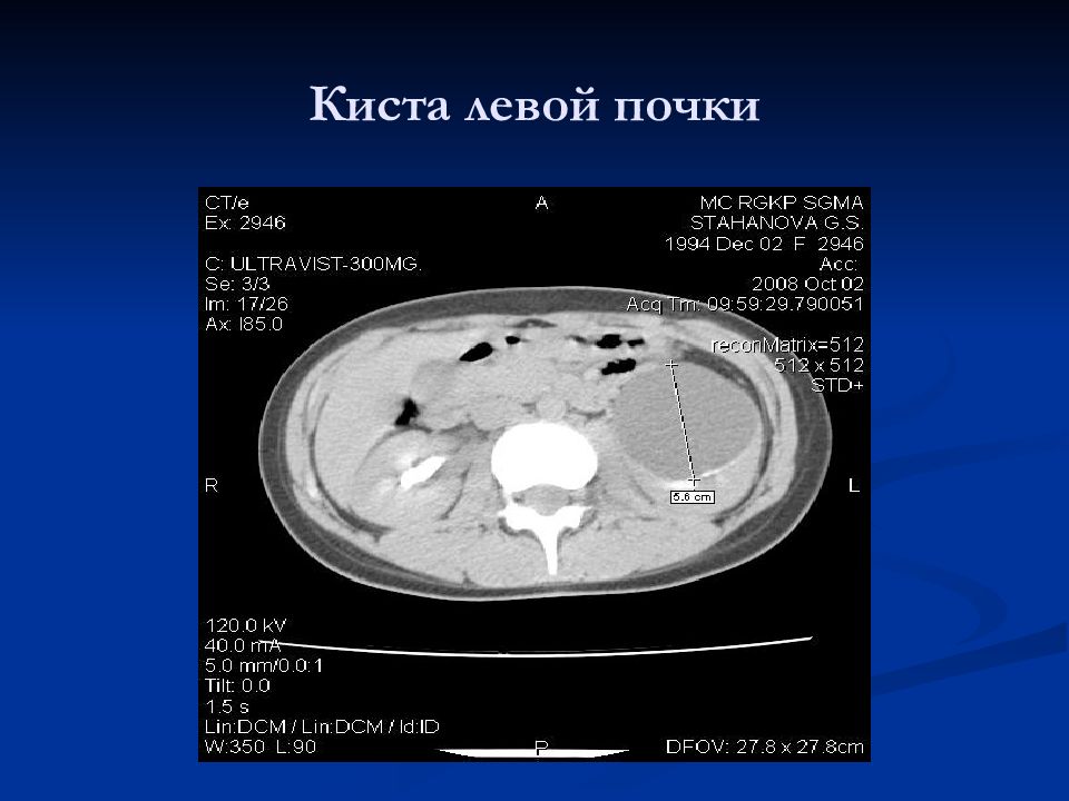 Киста почки нормы