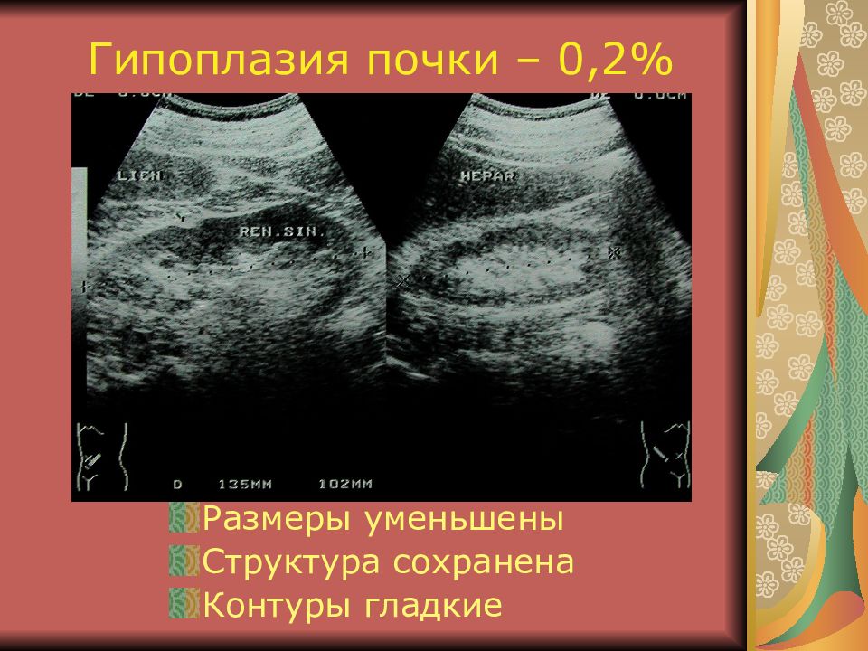 Гипоплазия почки. Размеры почки при гипоплазии. Уменьшение размеров почки на УЗИ.