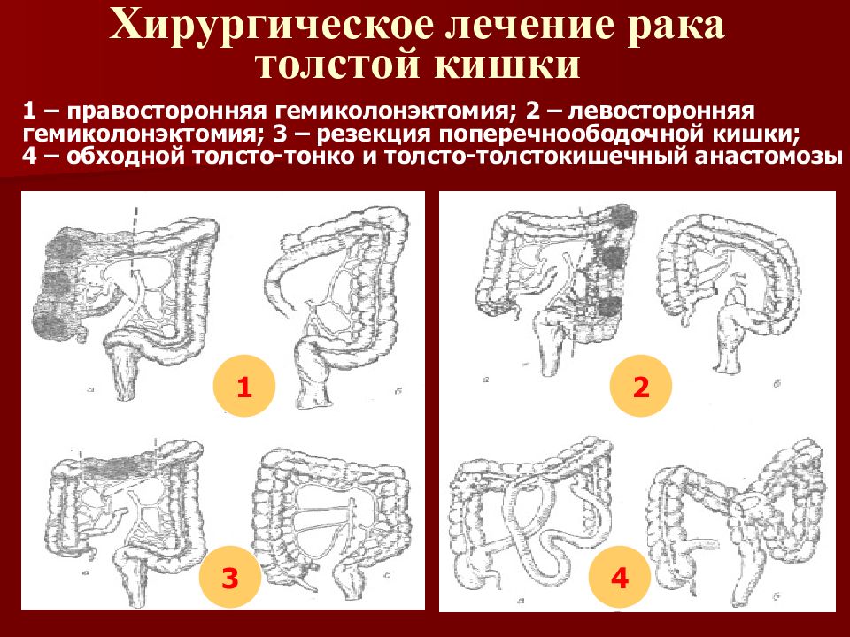 Рак прямой кишки рисунок