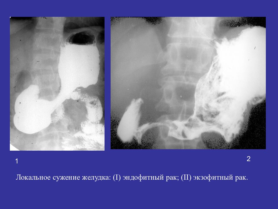 Экзофитный рак. Эндофитные опухоли желудке рентген. Экзофитная опухоль желудка рентген. Стеноз желудка рентгенодиагностика. Локальное сужение желудка.