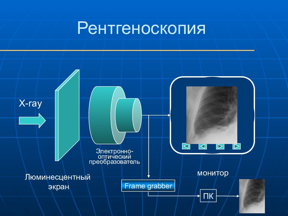 Это рентгенография с уменьшенным размером изображения получаемого на флюоресцирующем экране