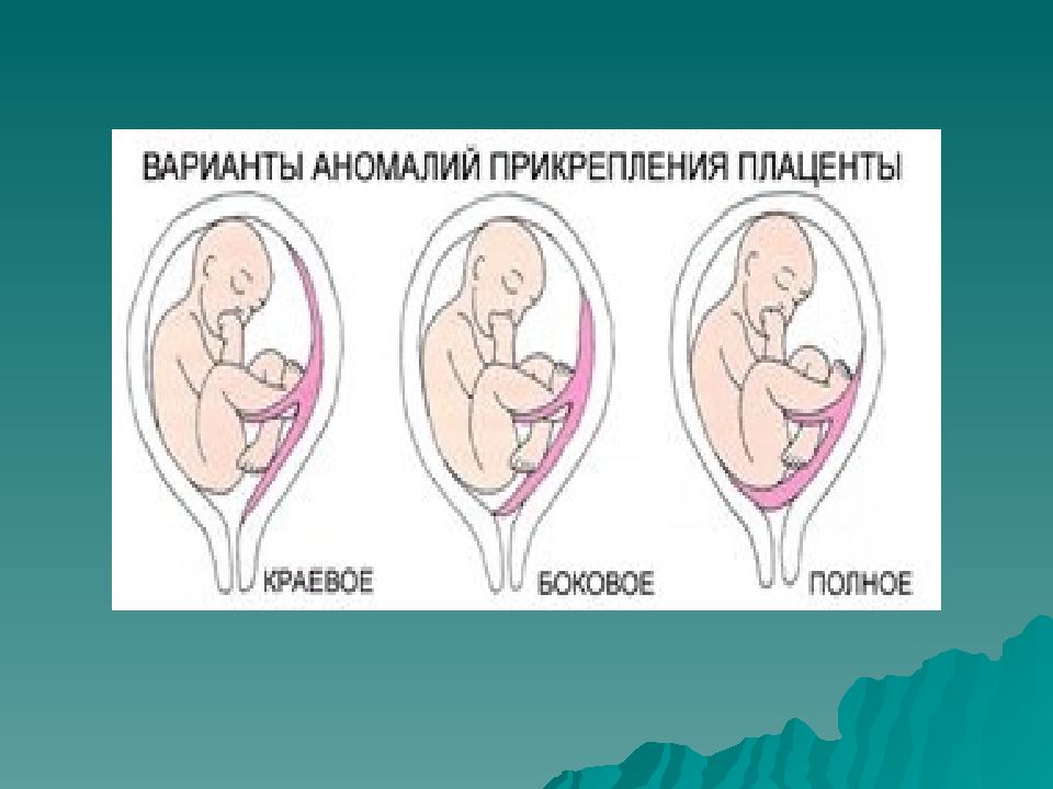 Аномалии развития плаценты презентация