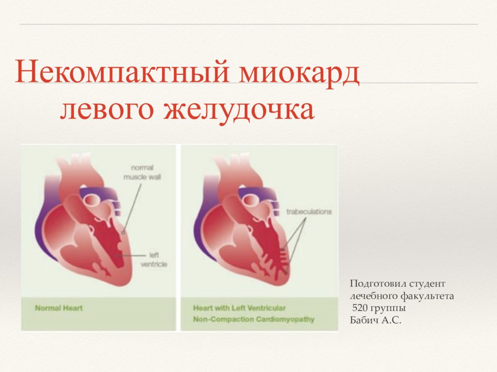 Миокарда левого. Некомпактный губчатый миокард. Некомпактный миокард УЗИ. Некомпактный миокард диагностические критерии. Некомпактный миокард клинические рекомендации.