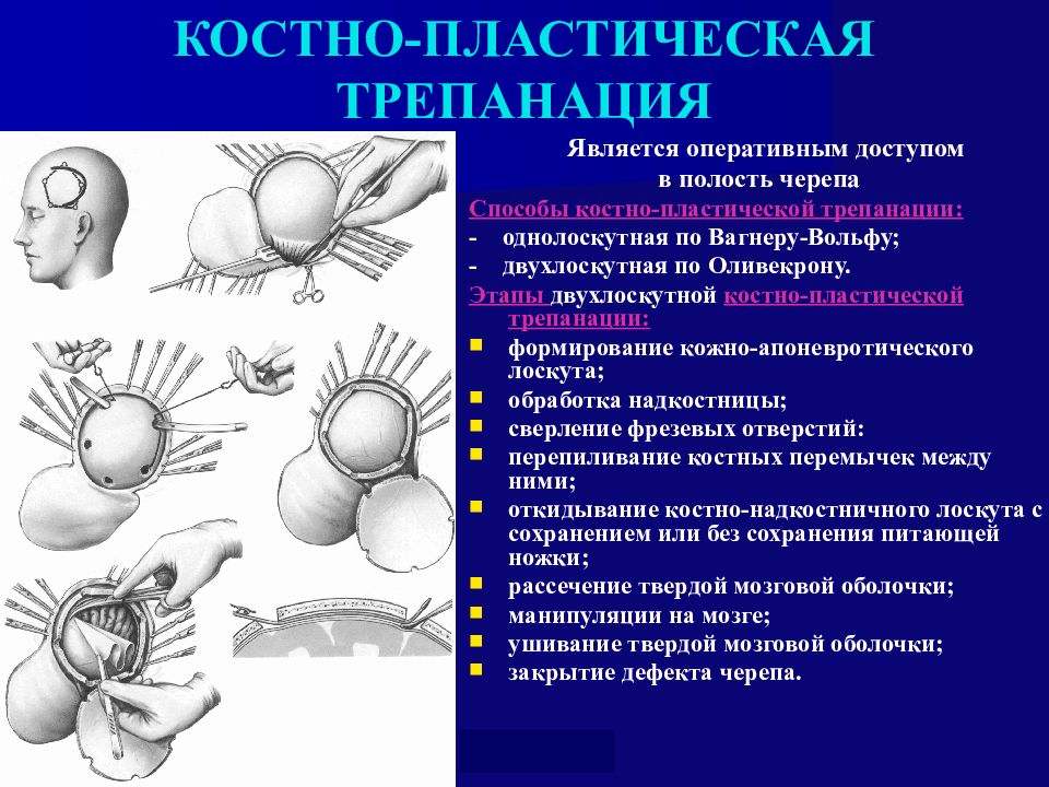 Трепанация по оливекрону. Костно-пластическая Трепанация по Вагнеру-Вольфу. Костнопластическая Трепанация черепа по Вагнеру-Вольфу. Этапы костно пластической трепанации по Оливекрону. Костно-пластическая Трепанация черепа по Оливекрону.