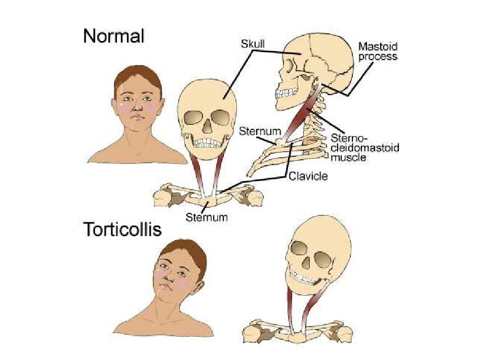 Нормальное состояние человека. Спастическая кривошея тортиколлис. Спастическая мышечная кривошея. Тортиколлис у взрослых.