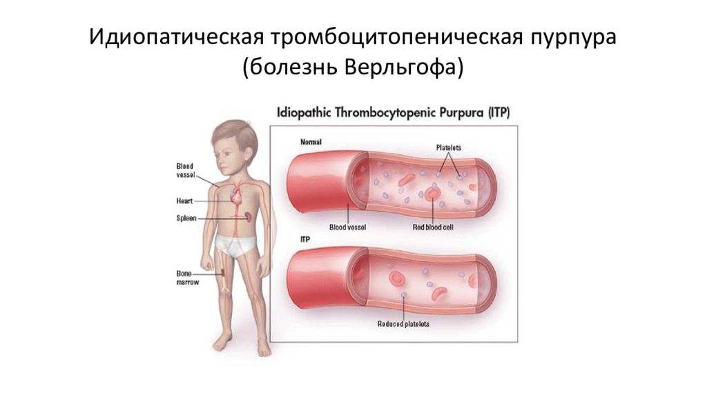 Идиопатическая тромбоцитопеническая пурпура презентация