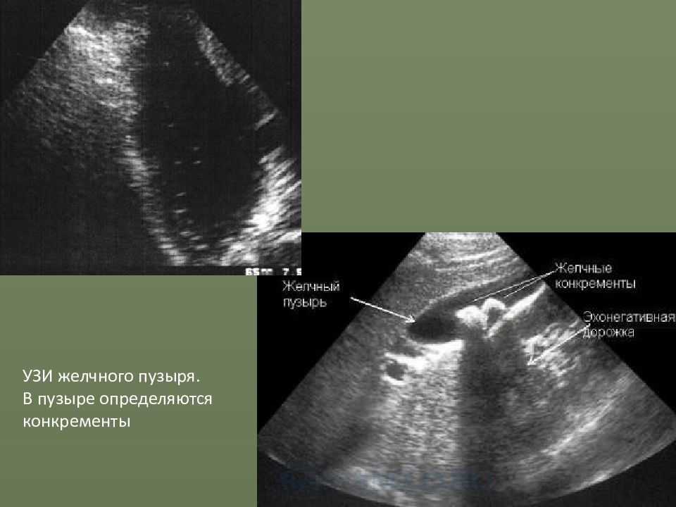Узи печени и желчного. УЗИ печени и желчного пузыря. Аденомиоматоза желчного пузыря УЗИ. Ультрасонография желчного пузыря. УЗИ желчного пузыря и протоков.