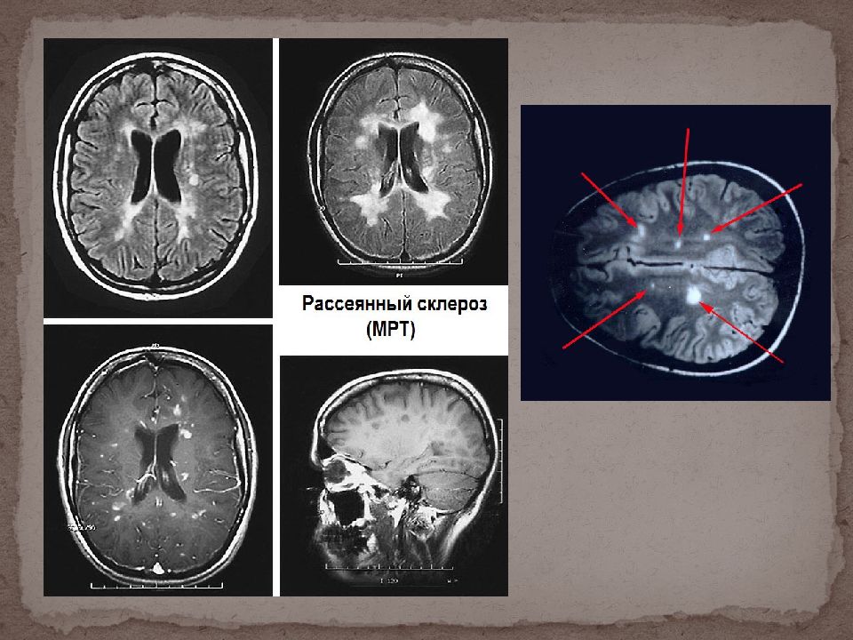 Мрт диагностика рассеянного склероза