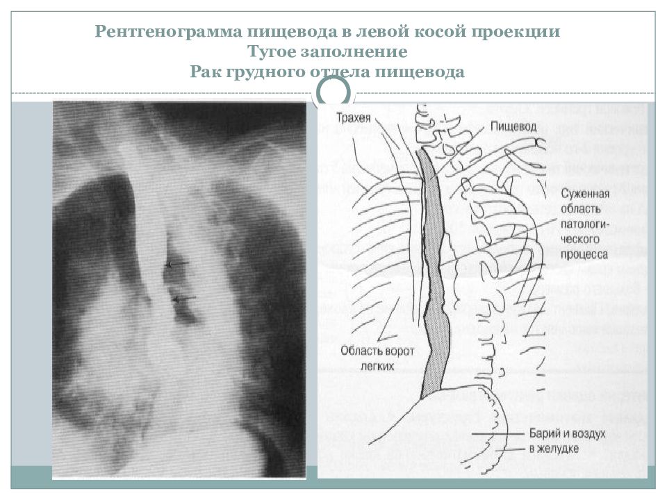 Рентгенография пищевода. Тугое заполнение пищевода рентгенограмма. Правая косая проекция пищевода. Рентгеноанатомия пищевода схема. Анатомия пищевода рентген.