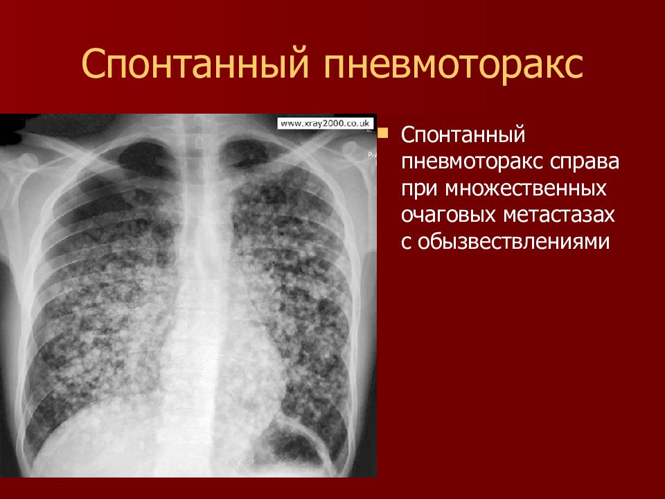 Спонтанный пневмоторакс презентация