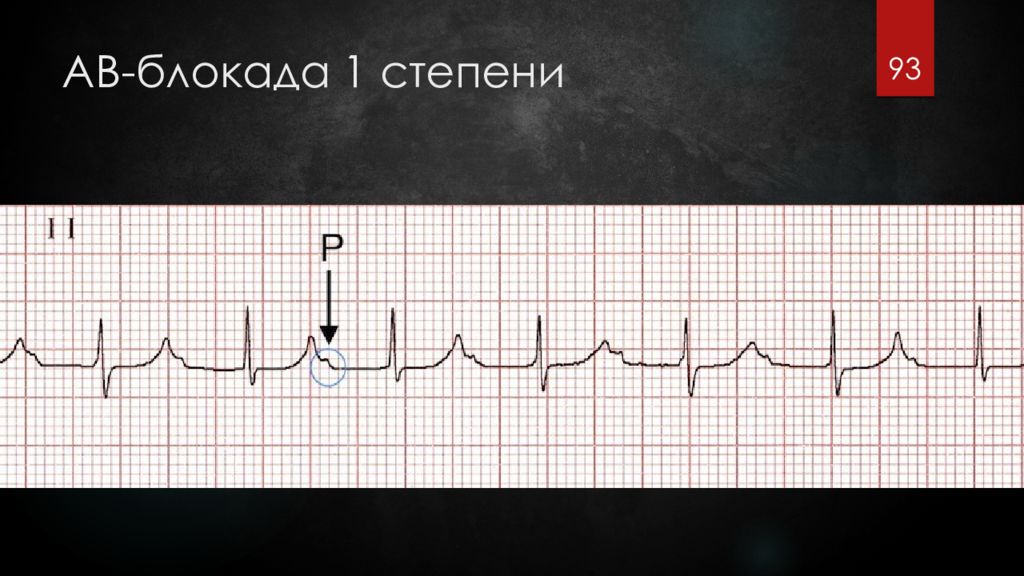 Ав блокада 1 степени. ЭКГ при АВ блокаде 1 степени. АВ блокада 1 степени на ЭКГ. Неполная АВ блокада 1 степени на ЭКГ. Атриовентрикулярная блокада 1 степени на ЭКГ.