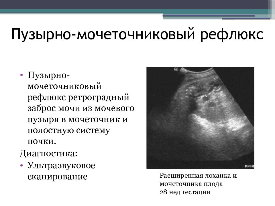 Рефлюкс нефропатия презентация