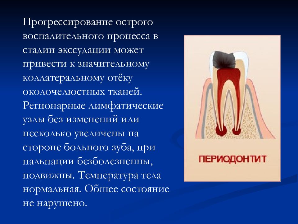 Лечение воспаления периодонтита. Острый апикальный периодонтит. Клинические проявления периодонтита.