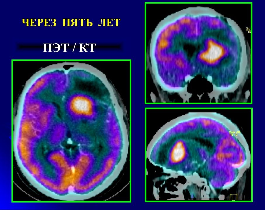 Пэт кт головного мозга. Астроцитома на ПЭТ кт. Диффузная астроцитома ПЭТ кт. Анапластическая астроцитома ПЭТ-кт.