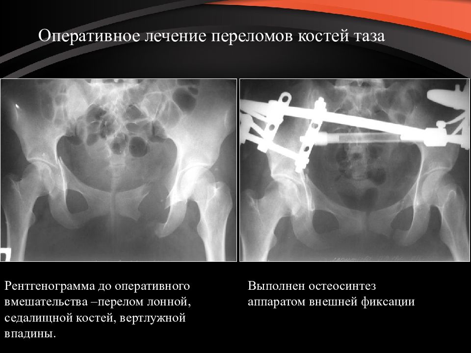 Презентация на тему перелом костей таза