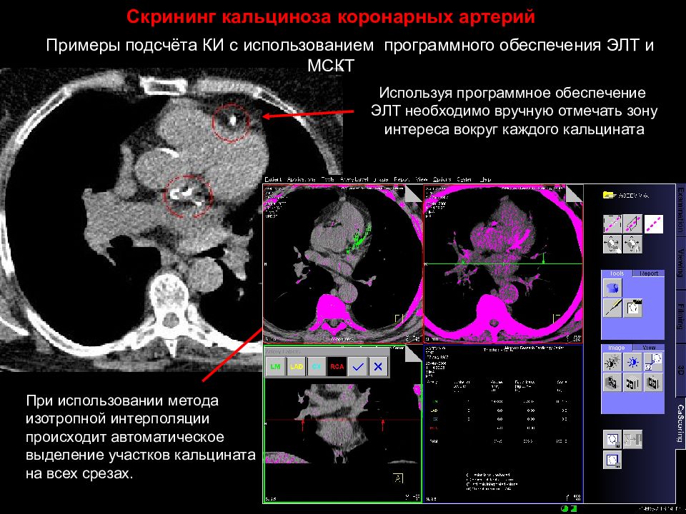 Кт скрининг коронарного кальция