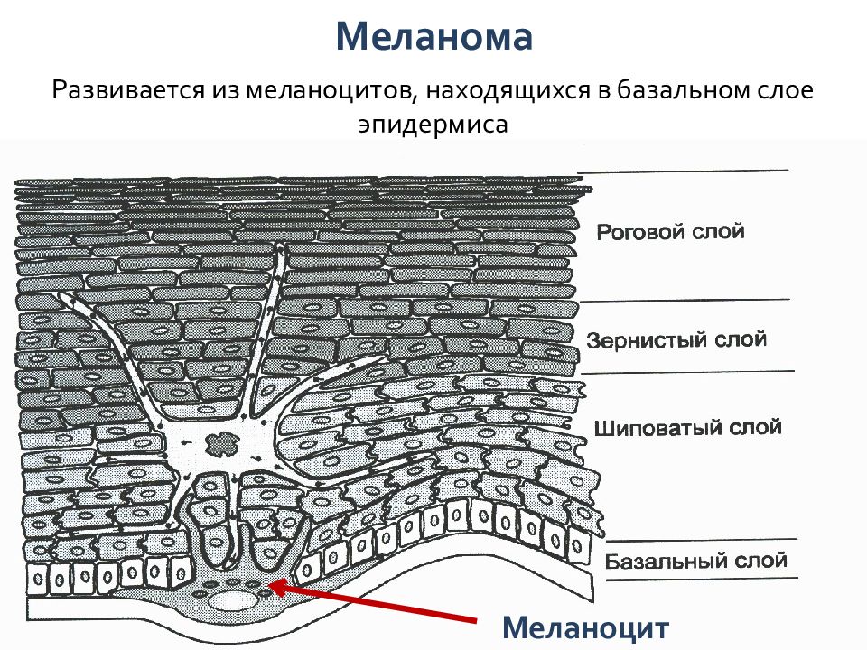 Меланома