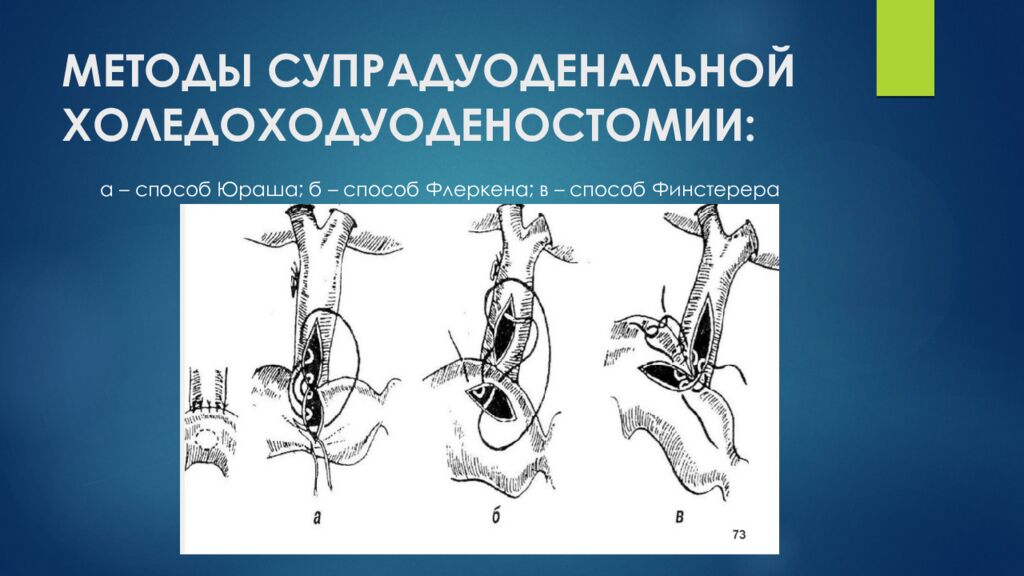 МЕТОДЫ СУПРАДУОДЕНАЛЬНОЙ ХОЛЕДОХОДУОДЕНОСТОМИИ: