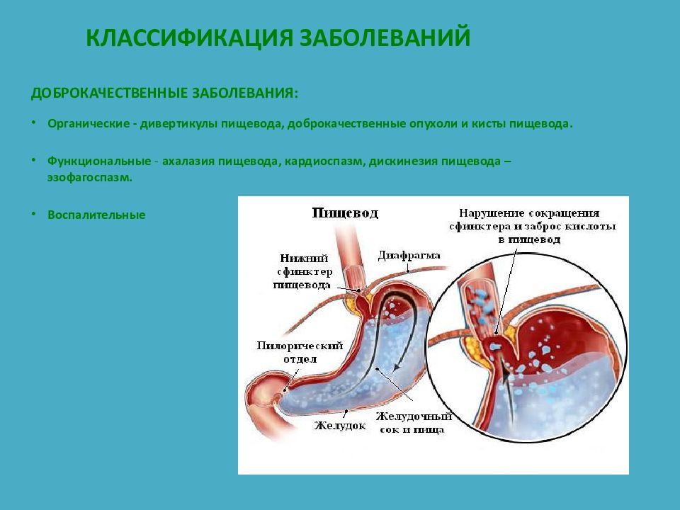 Хирургические заболевания пищевода презентация