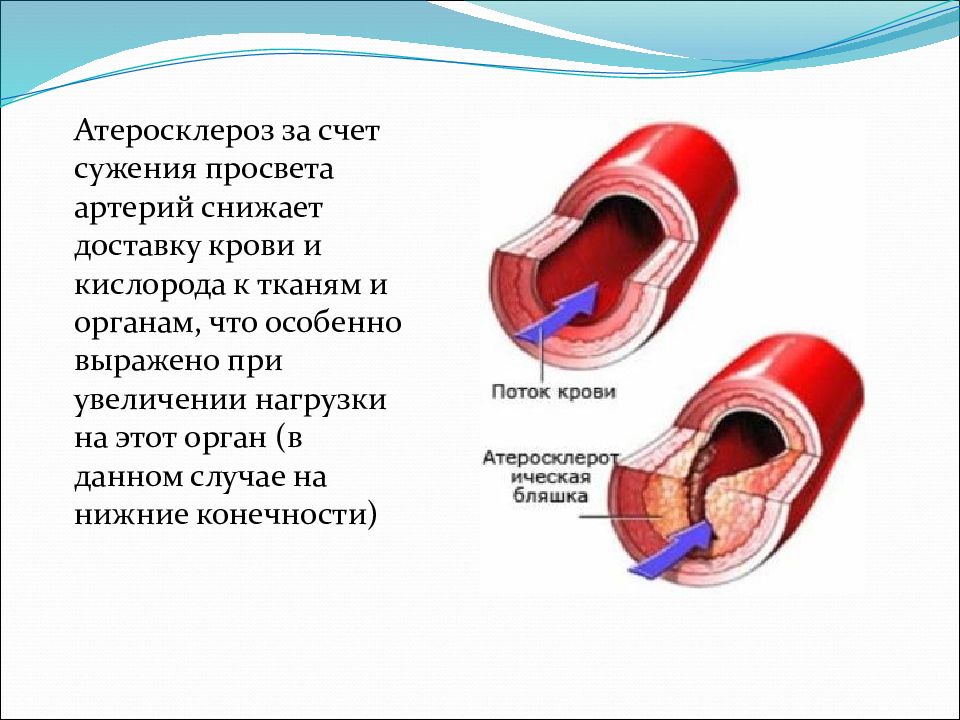 Почему расширяются сосуды. Стеноз просвета сосудов норма. Атеросклероз артерии просвет сосуда. Сужение просвета артерии.