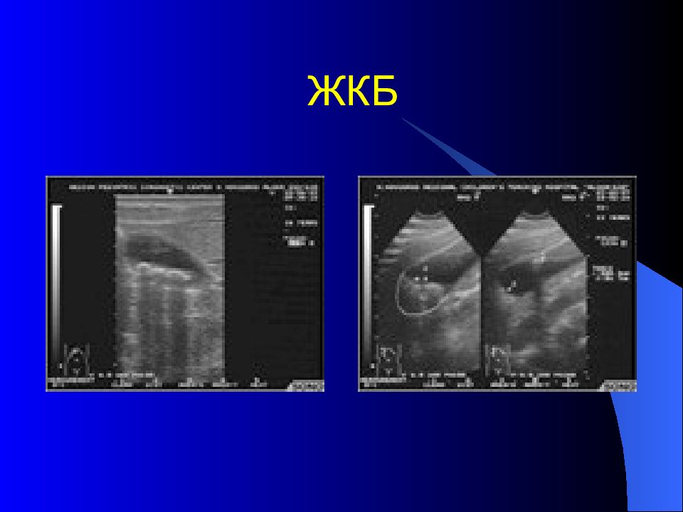 Узи забрюшинного пространства. Желчнокаменная болезнь лучевая диагностика. Лучевая диагностика брюшной полости. Лучевая диагностика органов брюшной полости. Лучевая диагностика болезней органов брюшной полости.