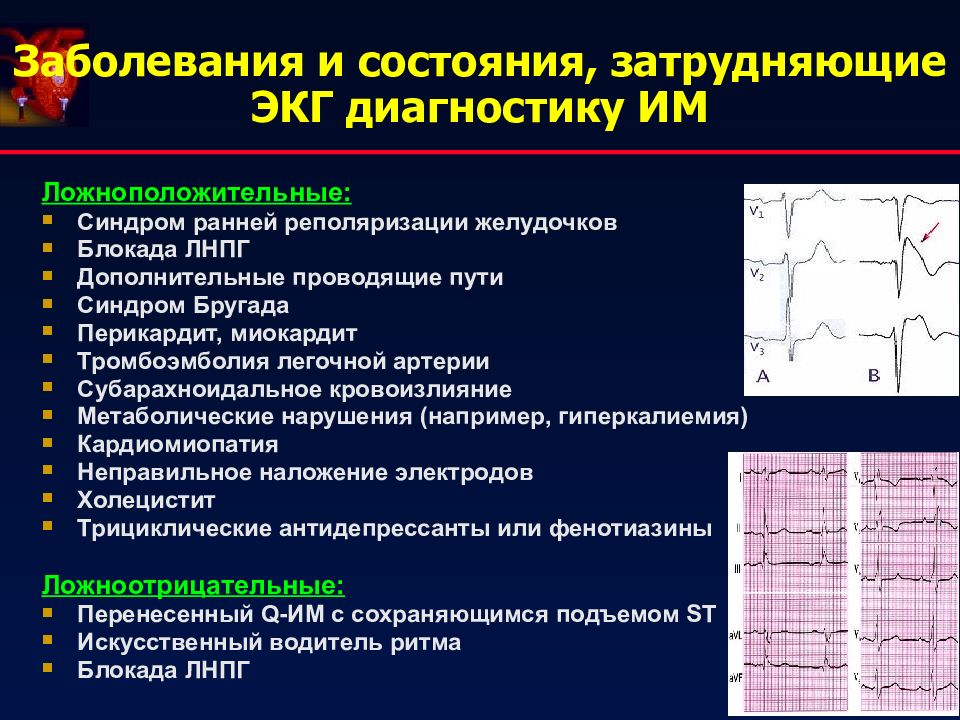 Синдром реполяризации желудочков у ребенка. Синдром ранней реполяризации желудочков ЭКГ критерии. Синдром ранней реполяризации ЭКГ критерии. Ранняя реполяризация желудочков по ЭКГ. ЭКГ при синдроме ранней реполяризации.