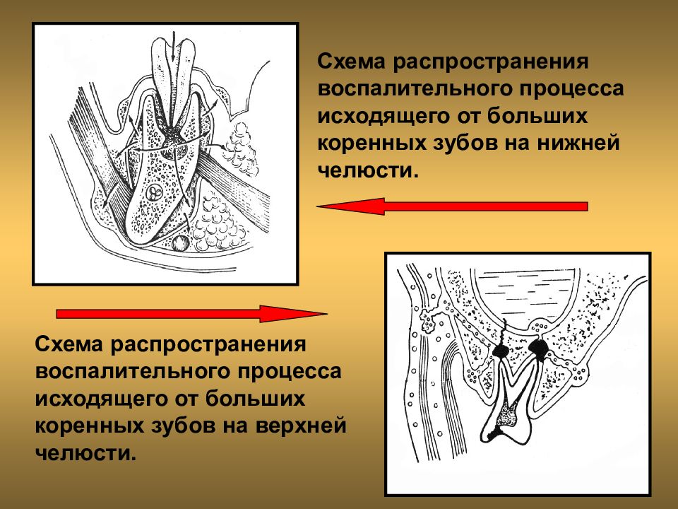 Этиология абсцесса и флегмоны. Пути распространения одонтогенного остеомиелита. Одонтогенный периостит этиология. Остеомиелит челюсти флегмона. Этиология одонтогенного остеомиелита.