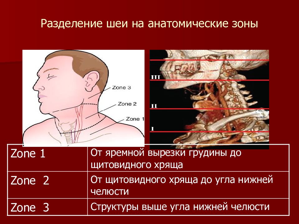 Зоны ранения