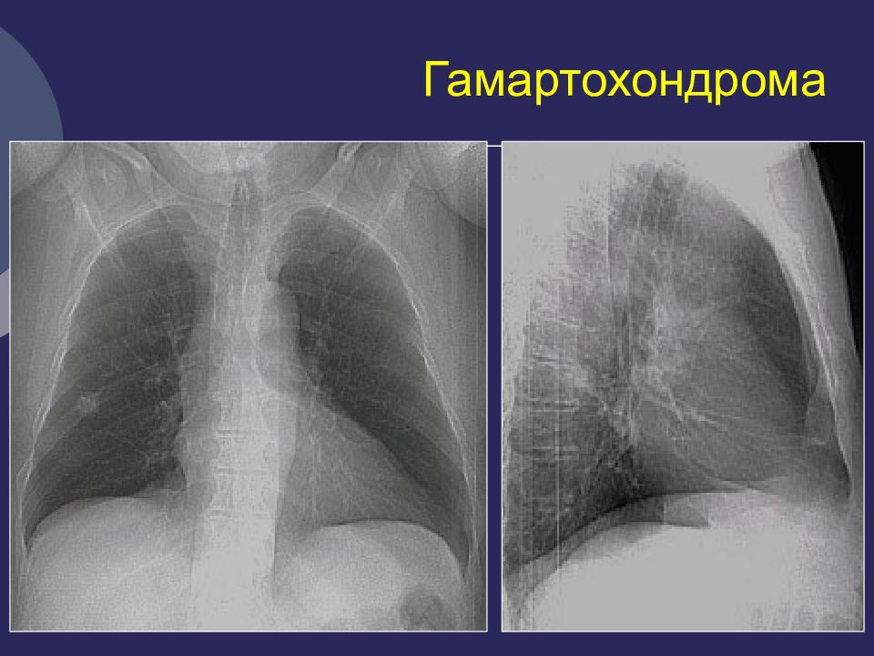 Кисты легких у детей презентация