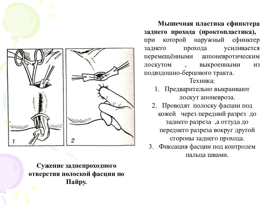 Презентация операции на прямой кишке