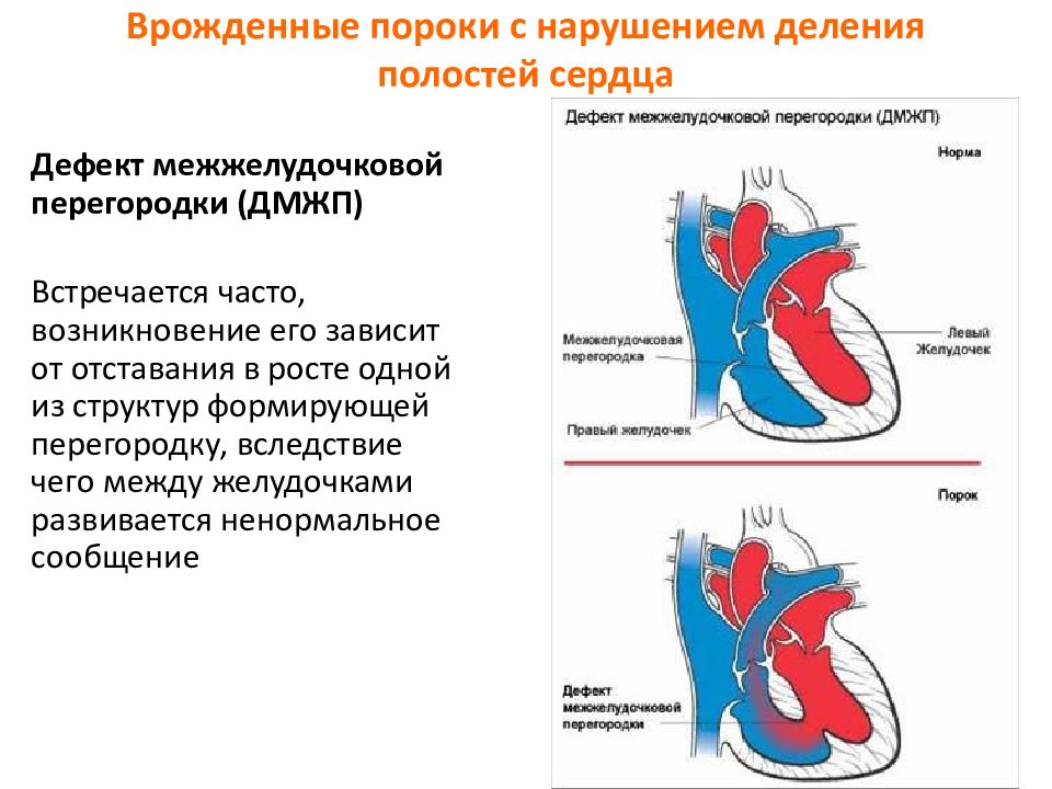 Часто встречаются сердца. Врожденные пороки сердца дефект межжелудочковой перегородки(ДМЖП). Классификация врожденных пороков сердца схема. Гемодинамика при врожденных пороках сердца схема. Врожденные пороки сердца схема.