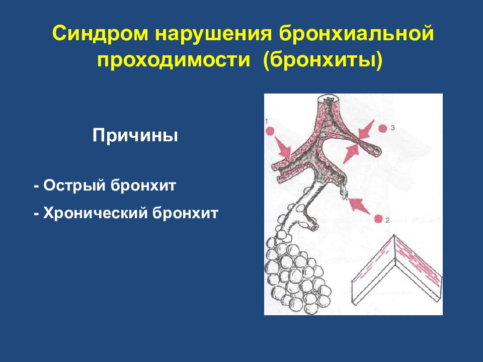 Дренаж бронхиального дерева как делать. Синдром нарушения бронхиальной проходимости. Синдром нарушения бронхиальной проводимости пропедевтика. Синдром нарушения бронхиальной проходимости пропедевтика. Нарушение проходимости бронхов.